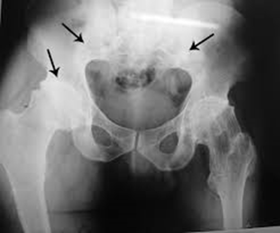 Coexistence of Ankylosing Spondylitis  {faces}